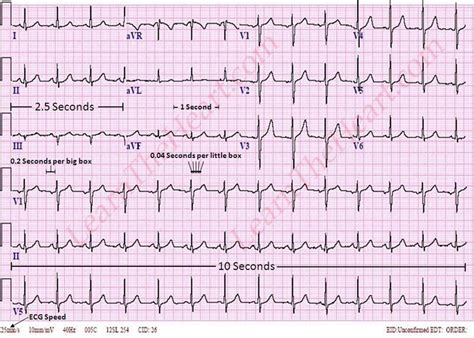 ecg 12 lead normal|Learning to Interpret 12.